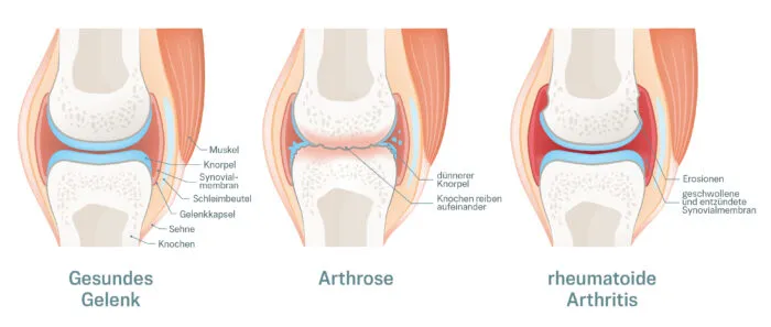 Vergleich von Rheuma oder Arthrose betroffenem Knie