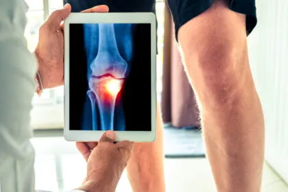 Arthrose im Knie: Diese Tipps können helfen, sie einzudämmen