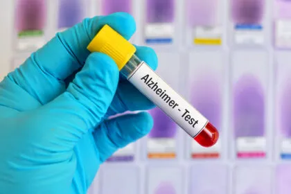 Neue Alzheimer-Bluttests: Durchbruch in der Früherkennung - oder gefährliche Falle für Patienten?