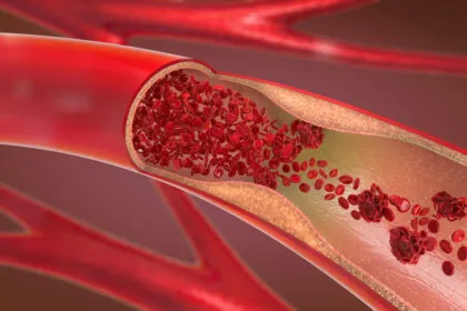 Atherosklerose: Die stille Gefahr für ihre Arterien - diese Warnzeichen gibt es